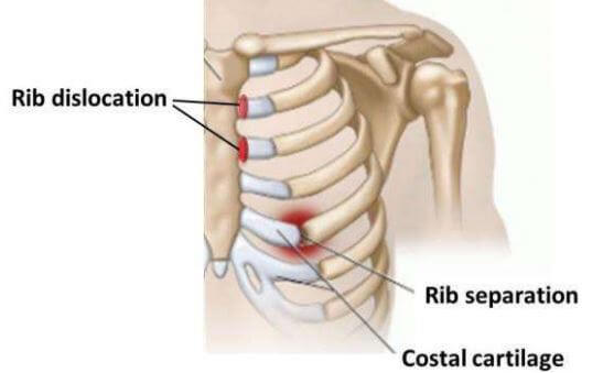 Rib dislocation separation coastal cartilage
