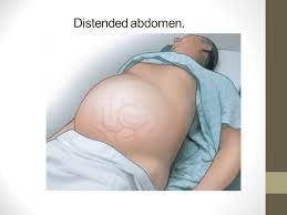 Distended Abdomen