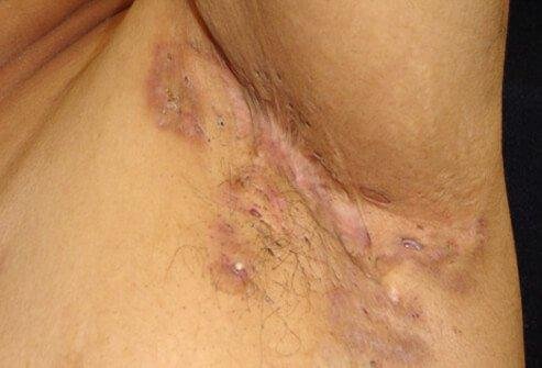 Hidradenitis Suppurativa