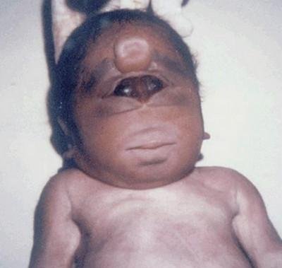 Cyclopia