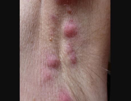 Hidradenitis suppurativa Pictures 3