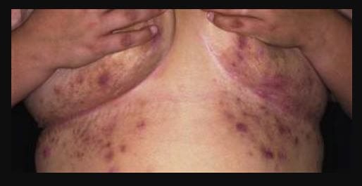 Hidradenitis suppurativa Pictures 5