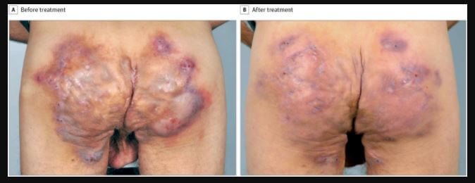 Hidradenitis Suppurativa Surgery, Treatment, Pictures