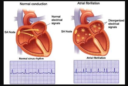 Paroxysmal Atrial Fibrillation