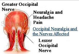 occipital neuralgia description symptoms nerve causes anatomical