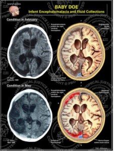 encephalomalacia progression prognosis