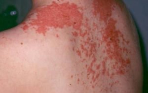 Maculopapular Rash - Pictures, Causes, Treatment, Definition, Signs