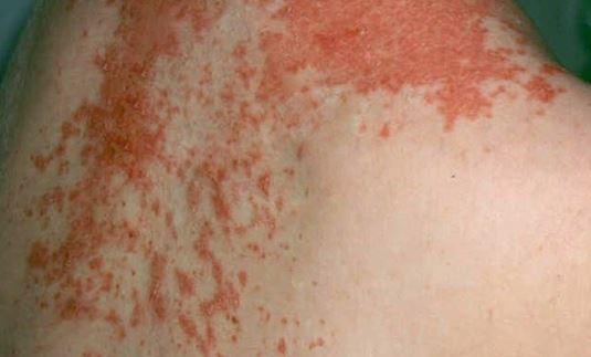 can sulfasalazine cause skin rash
