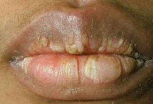 Crusty Lips - How to Get Rid, Symptoms, Causes, Remedies, Pictures