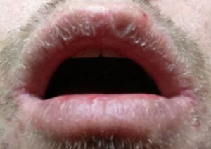Crusty Lips - How to Get Rid, Symptoms, Causes, Remedies, Pictures