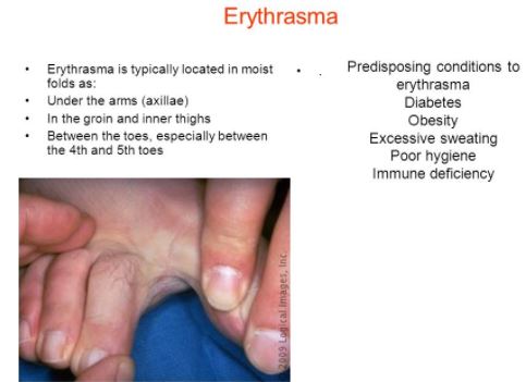 Erythrasma Images 5