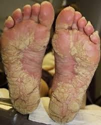 Hyperkeratosis of legs