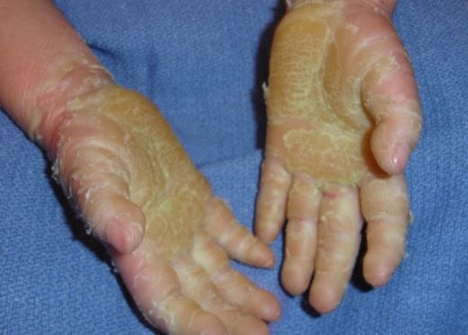 epidermolytic-hyperkeratosis