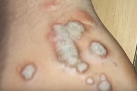 hyperkeratosis-images-6