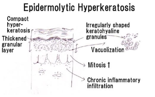 hyperkeratosis-images-7