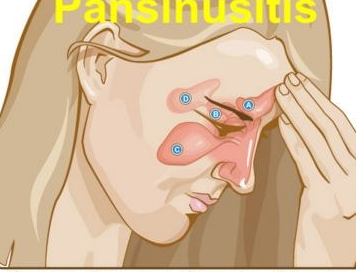 pansinusitis-3