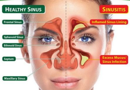 Pansinusitis