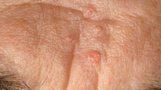 Sebaceous Hyperplasia images