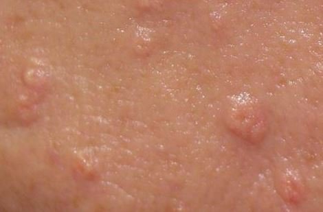 Sebaceous Hyperplasia pics 4