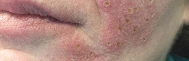 Sebaceous Hyperplasia pics 6