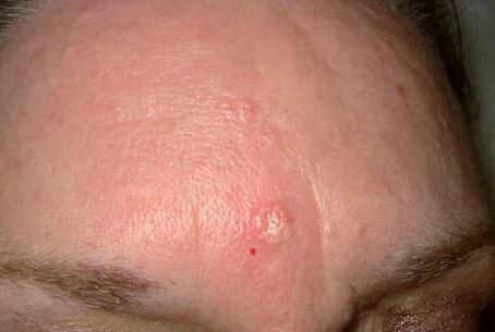 Sebaceous Hyperplasia